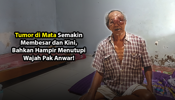 Idap Tumor Mata, Bantu Pak Anwar Bisa Lakukan Pengobatan - Donasi Online